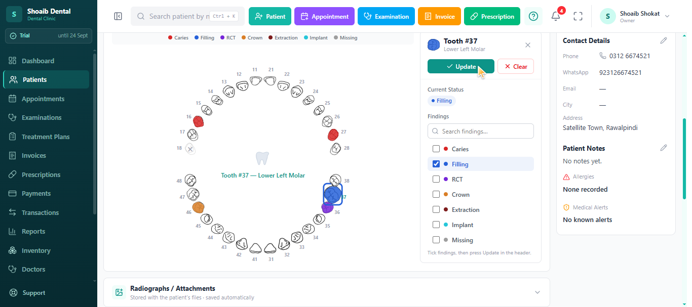 Dentrah interactive odontogram with caries, filling, RCT, crown and missing findings per tooth