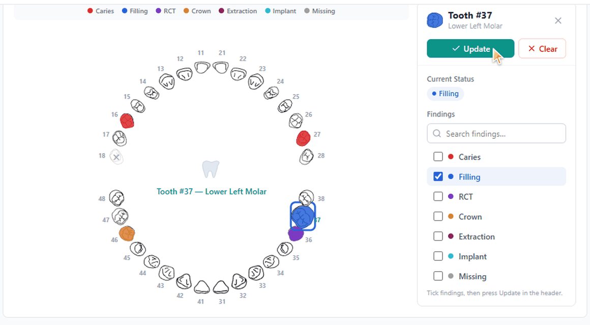 Dentrah dental charting software: FDI-numbered odontogram with colour-coded caries, filling, RCT, crown and missing tooth findings